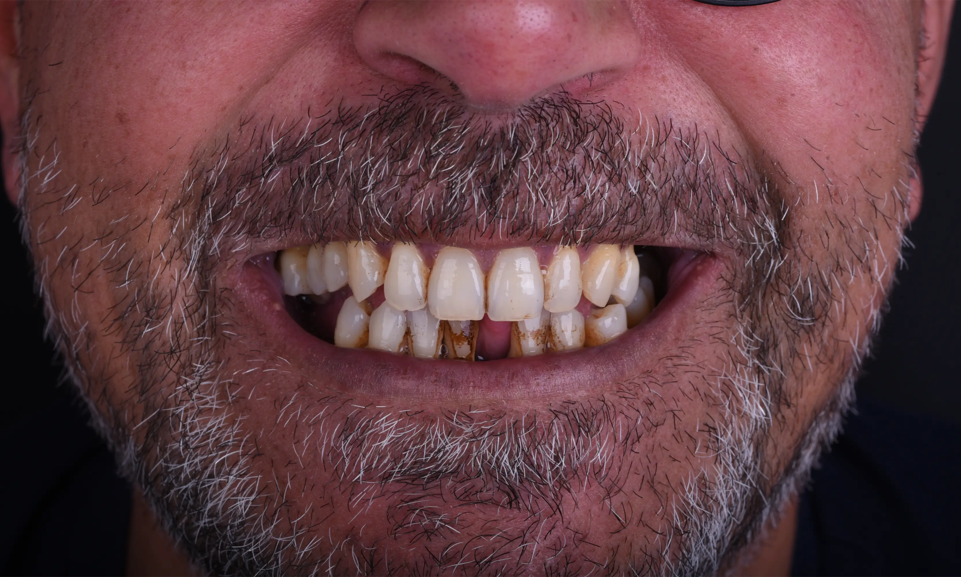 All on X Before - Case 14 - Milim Dental Hospital Bursa