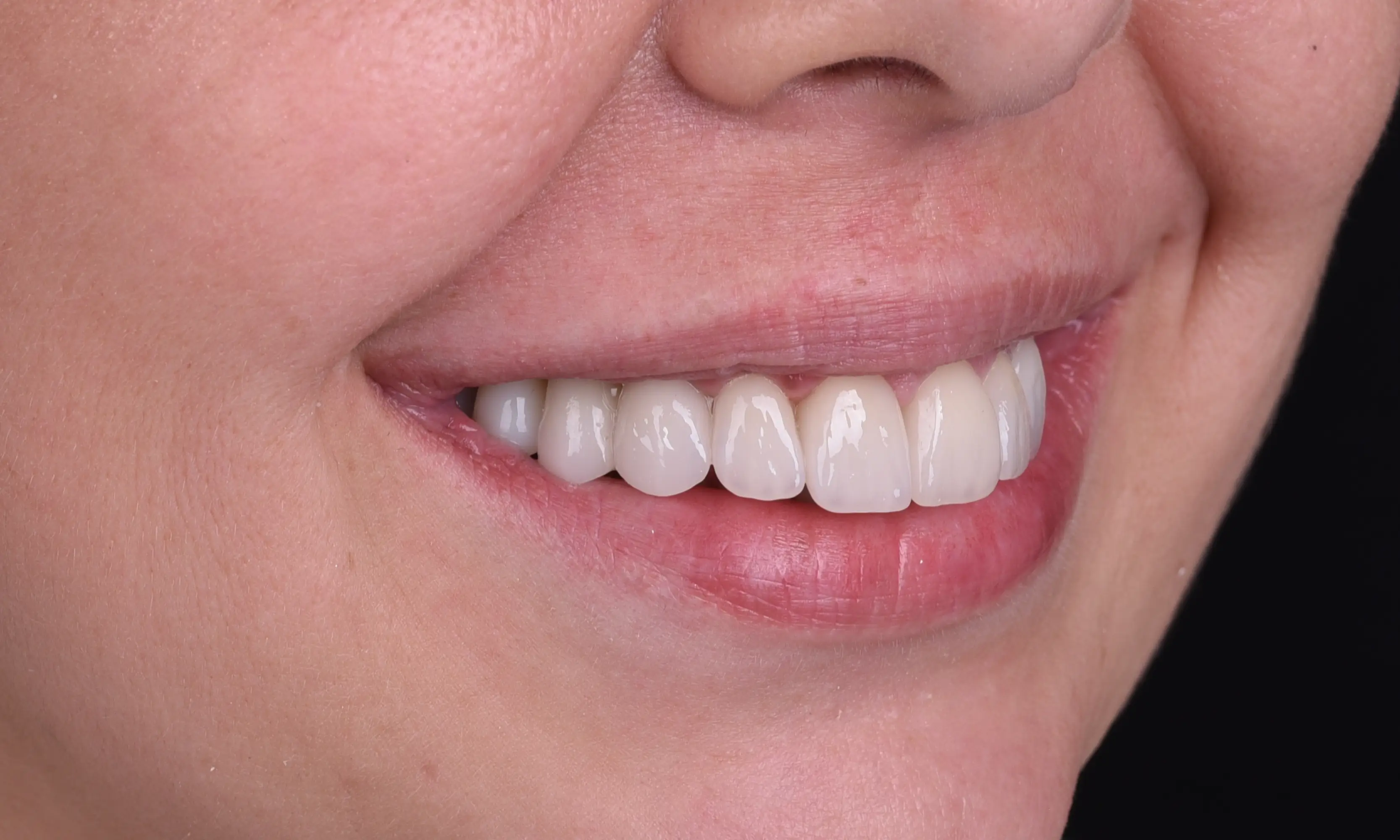 Full Veneers After - Case 15 - Milim Dental Hospital Bursa