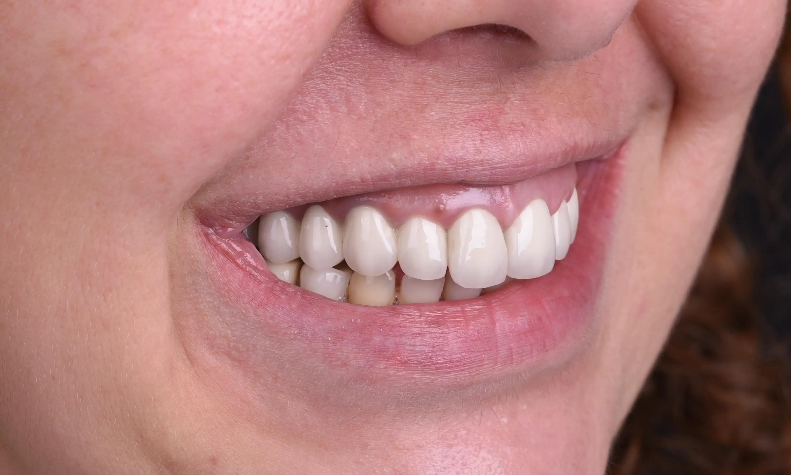 Full Veneers Before - Case 15 - Milim Dental Hospital Bursa