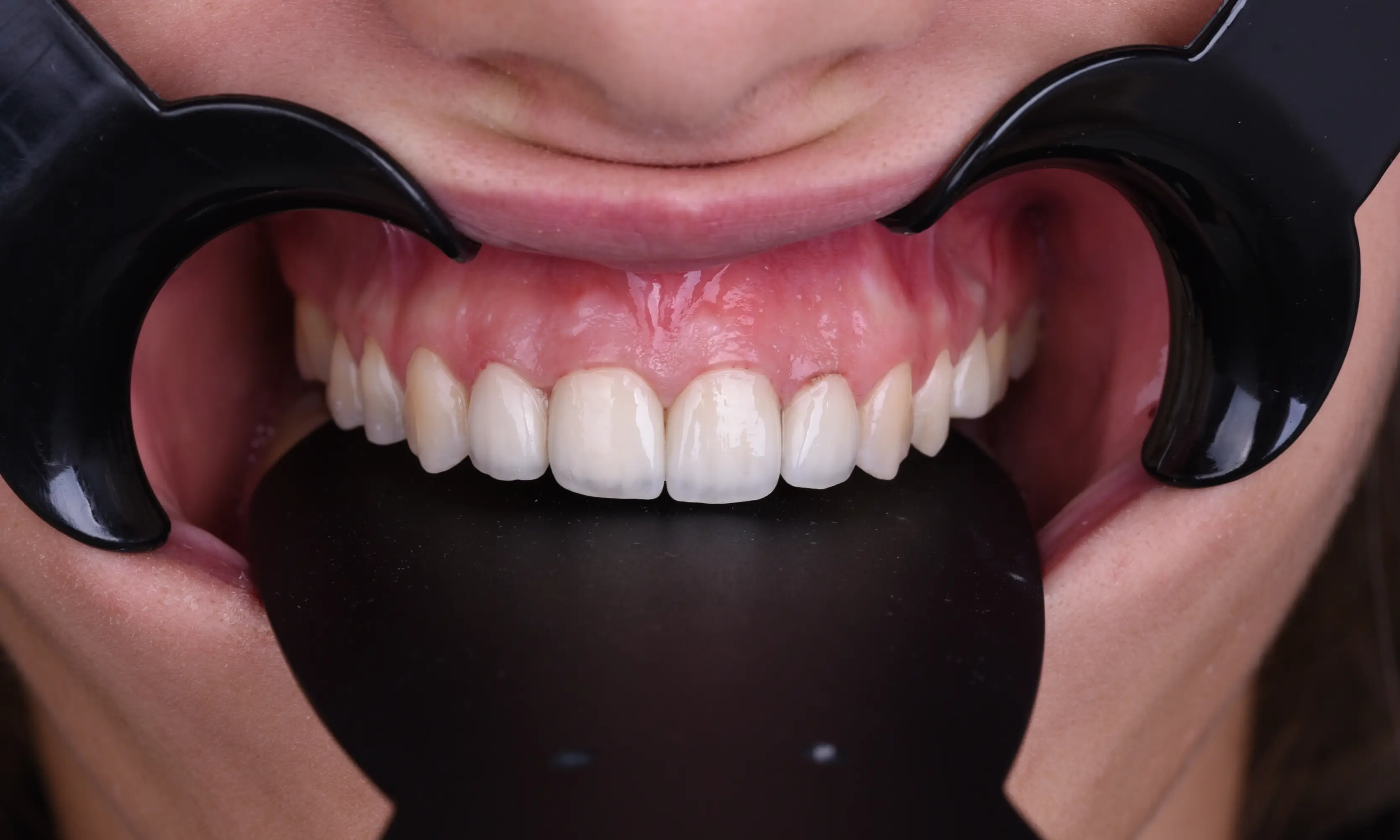 Full Veneers After - Case 18 - Milim Dental Hospital Bursa