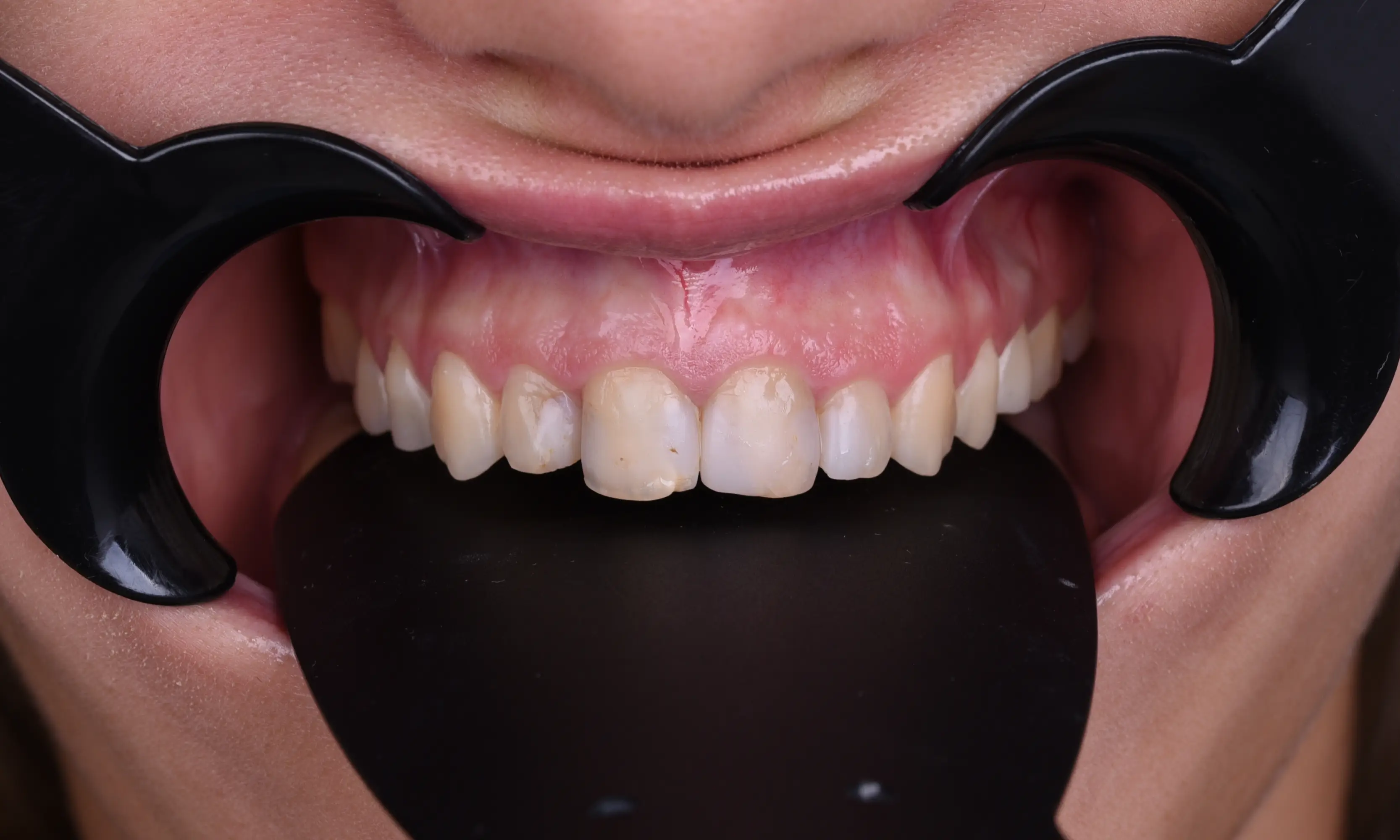 Full Veneers Before - Case 18 - Milim Dental Hospital Bursa