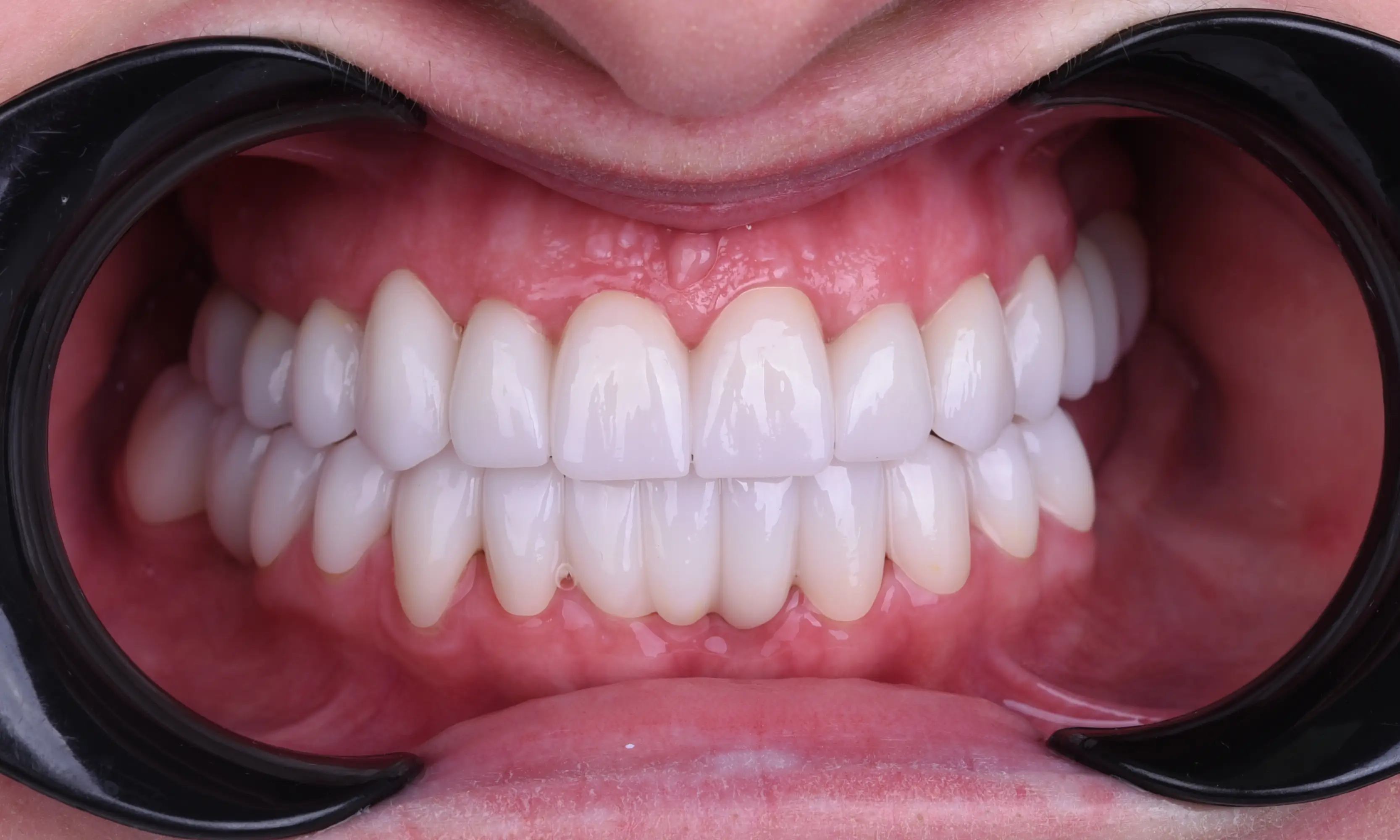 Full Zirconium After - Case 27 - Milim Dental Hospital Bursa