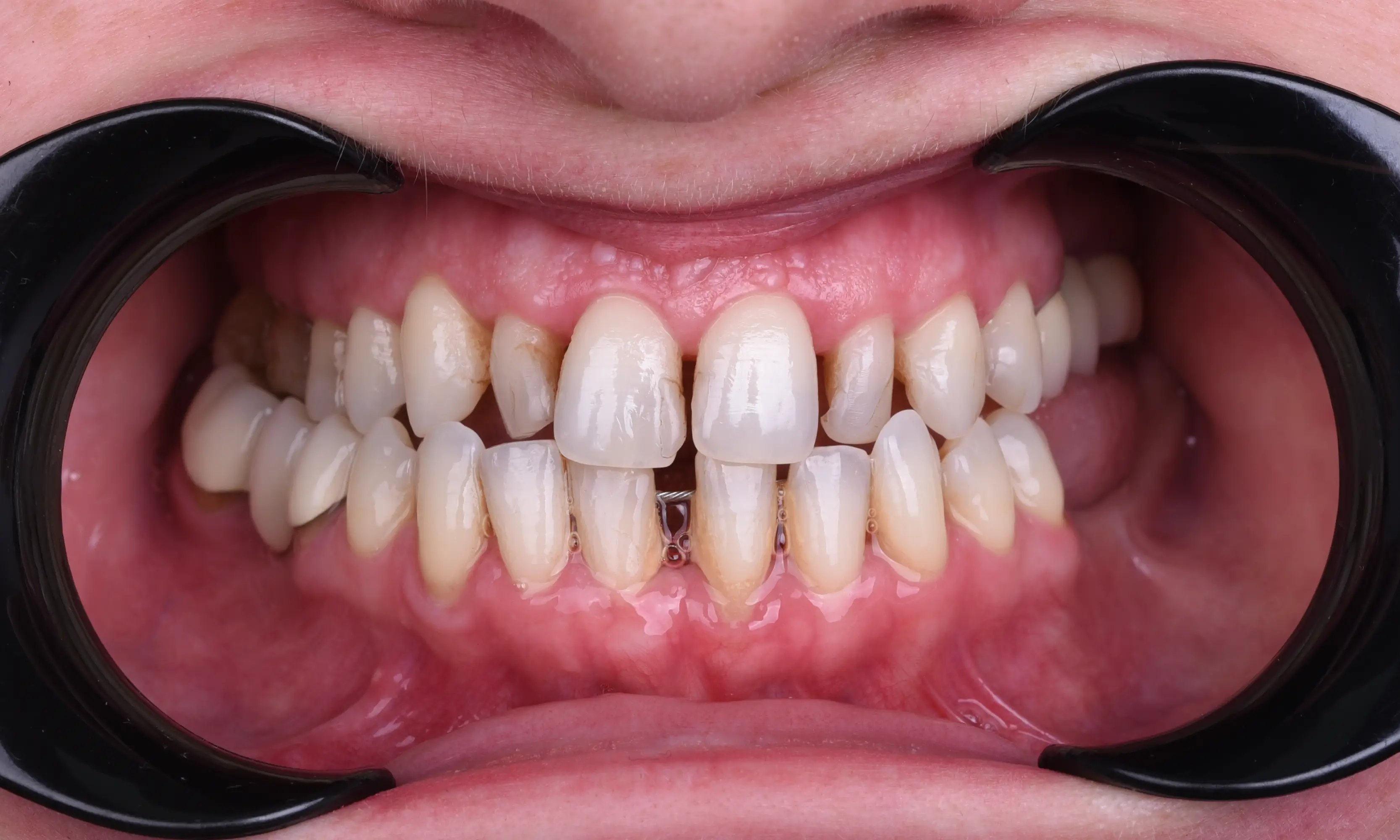 Full Zirconium Before - Case 27 - Milim Dental Hospital Bursa