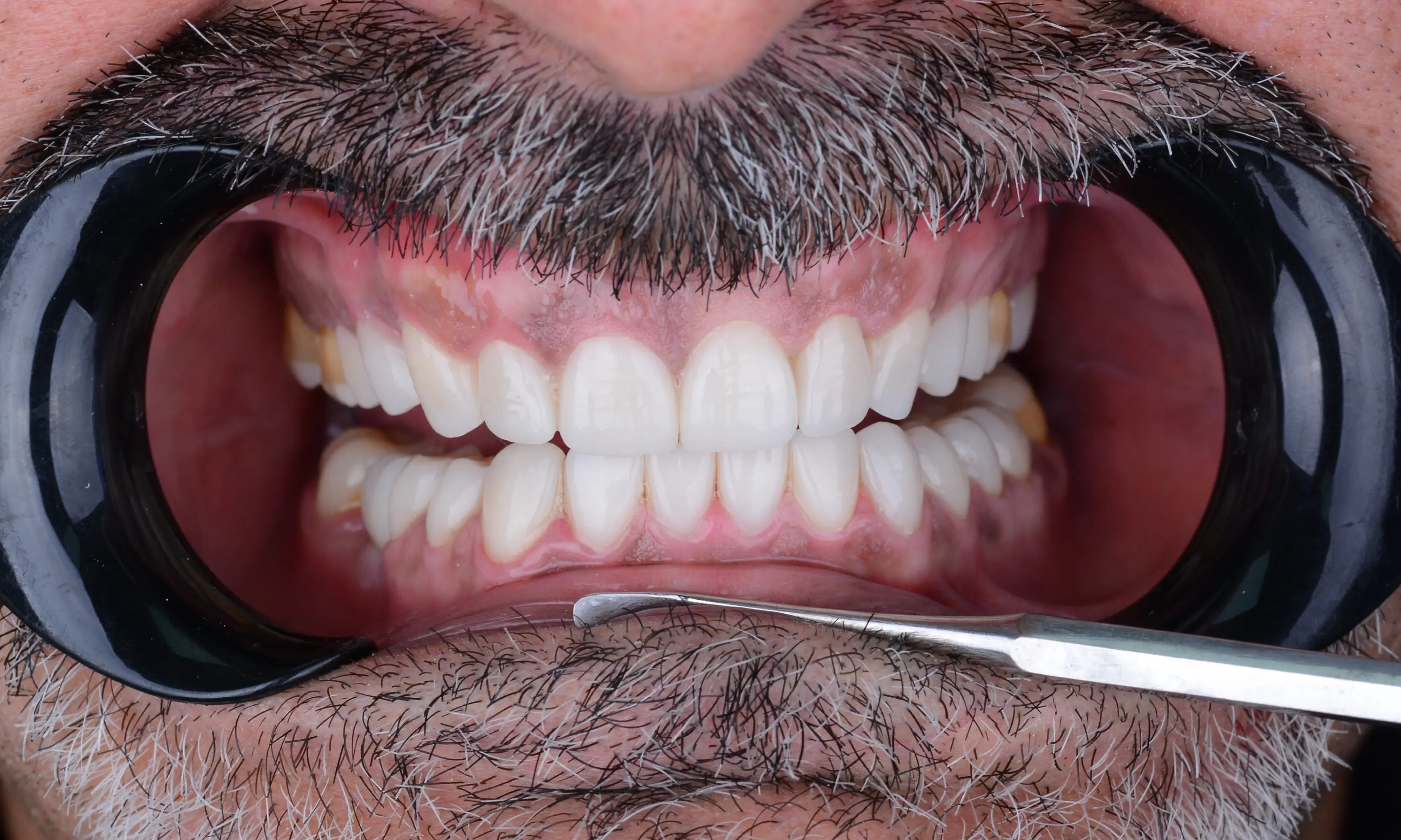 Full Veneers After - Case 29 - Milim Dental Hospital Bursa