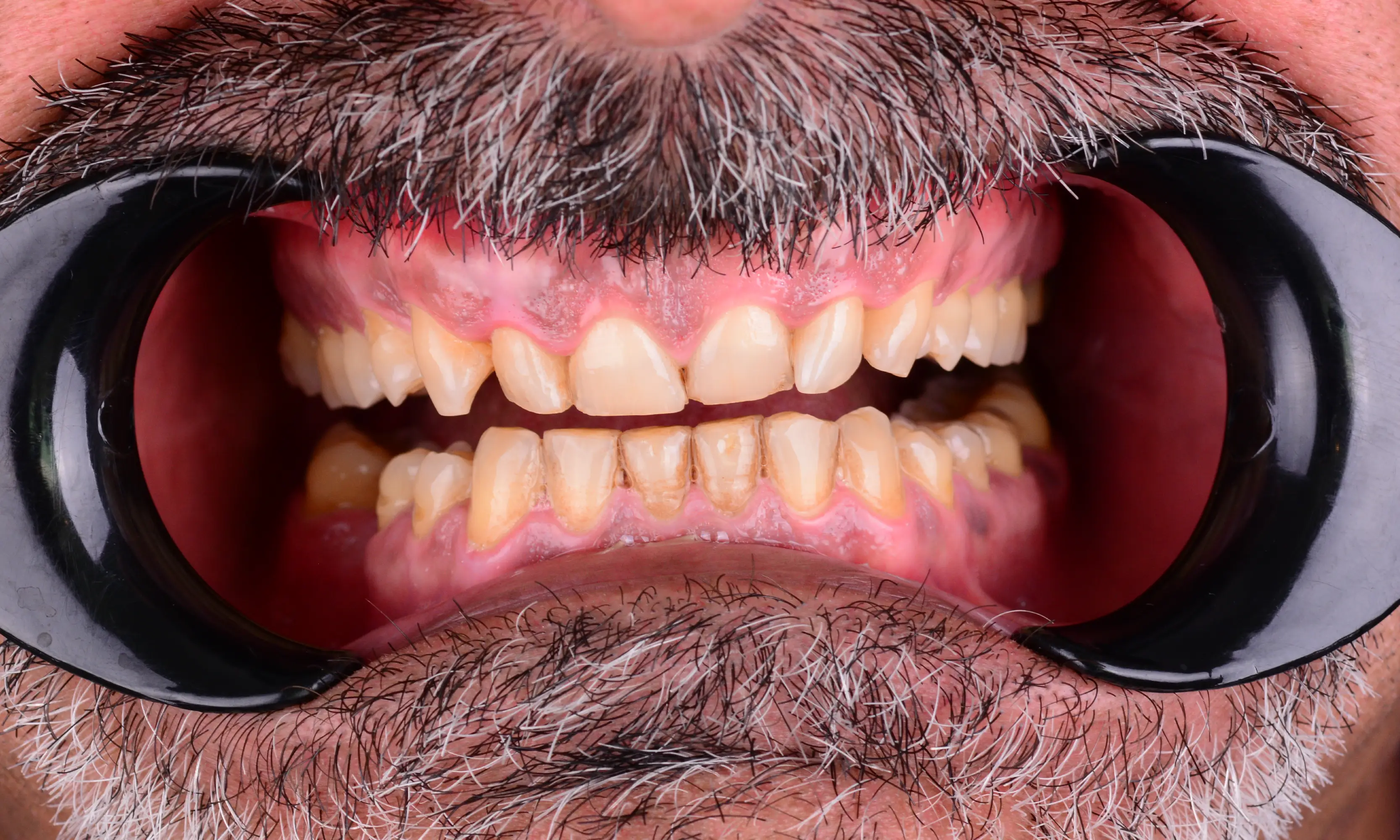 Full Veneers Before - Case 29 - Milim Dental Hospital Bursa