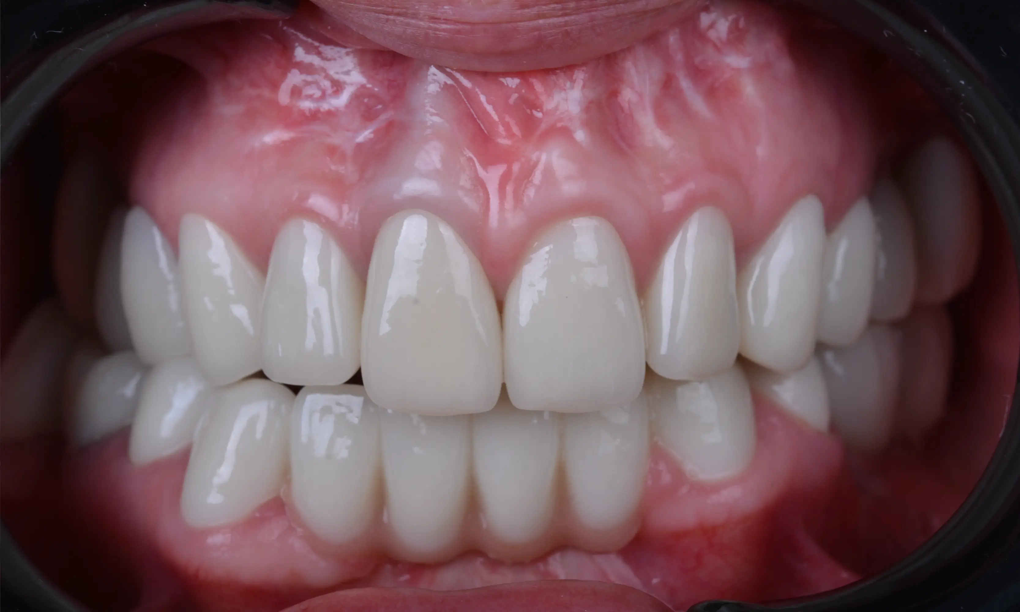 Full Veneers After - Case 30 - Milim Dental Hospital Bursa