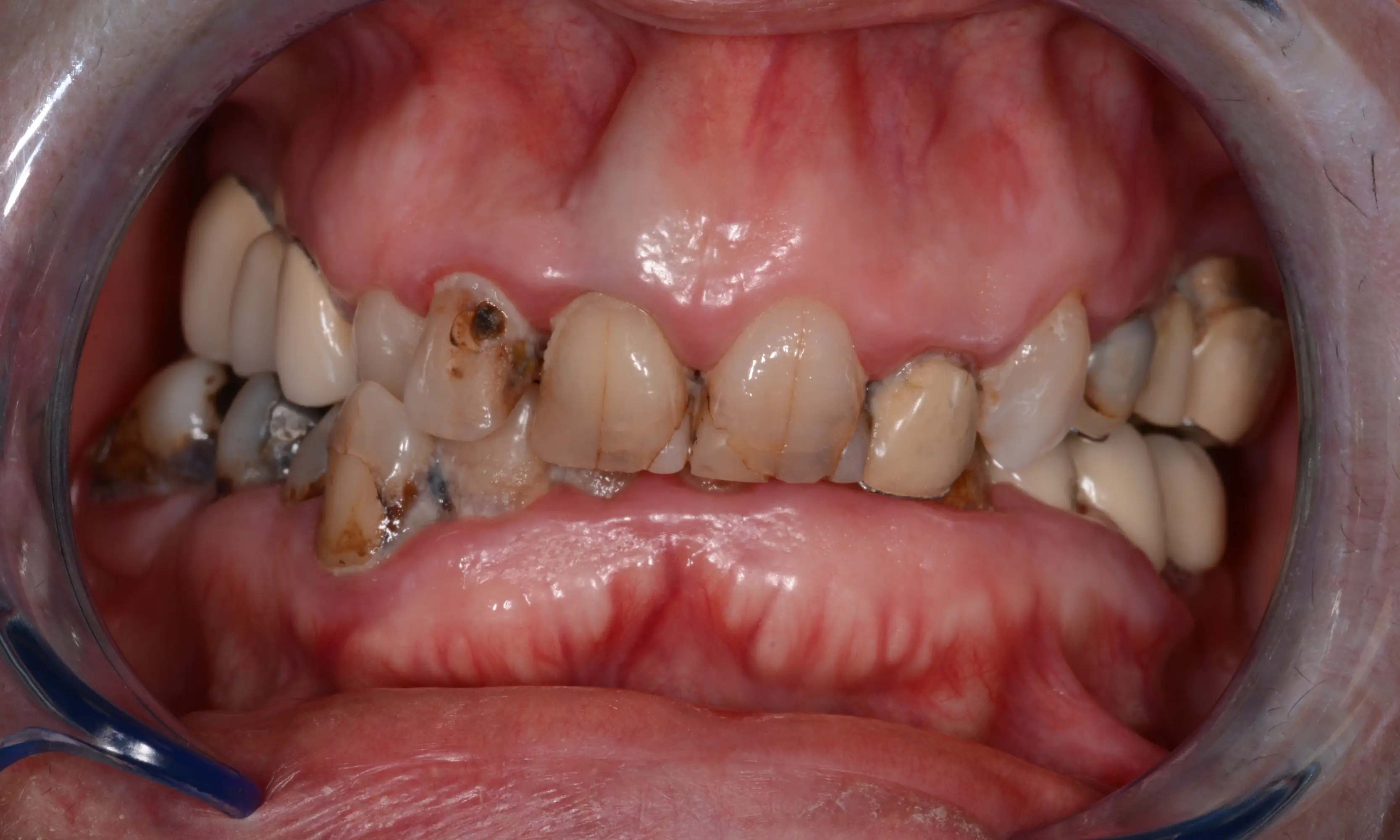 Full Veneers Before - Case 30 - Milim Dental Hospital Bursa