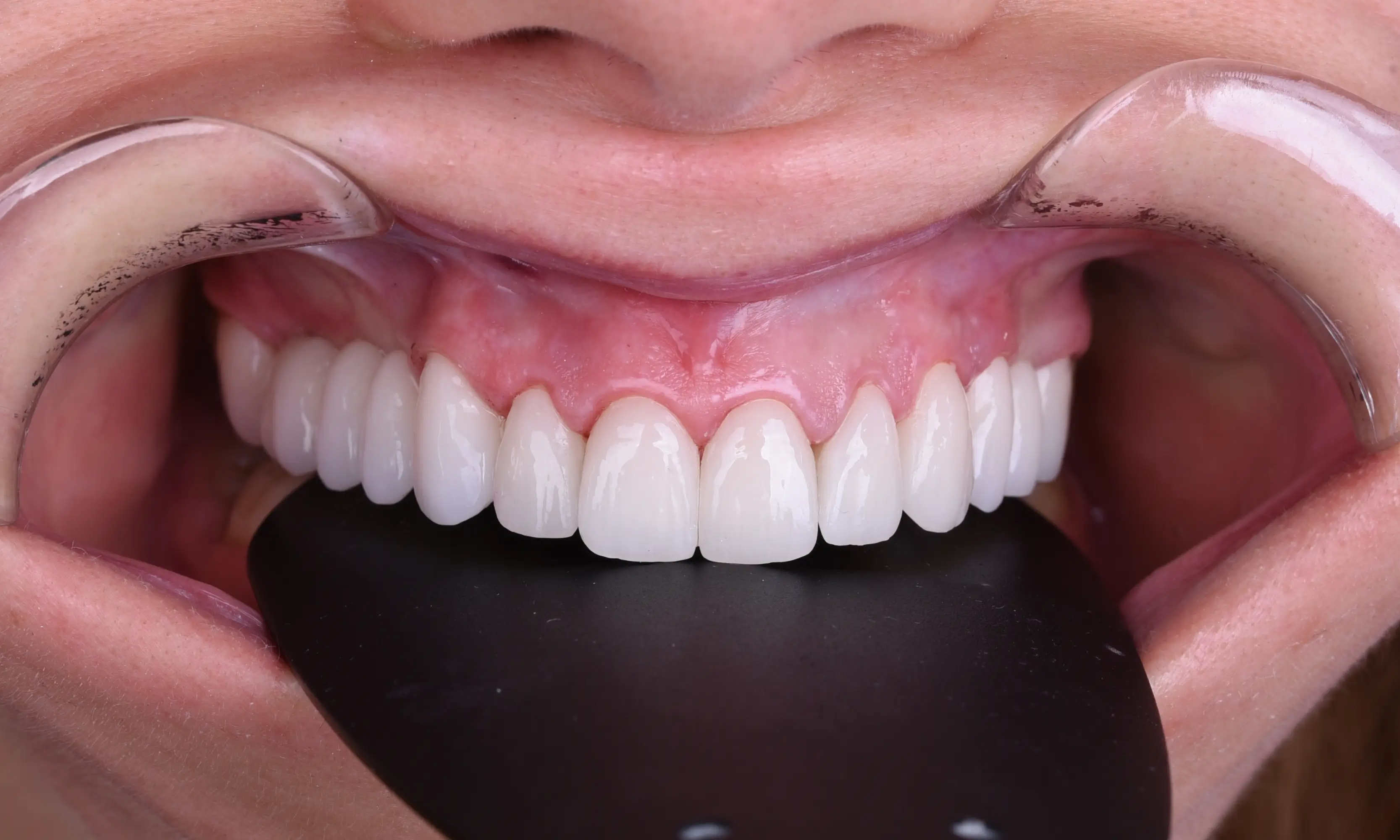 Full Veneers After - Case 33 - Milim Dental Hospital Bursa