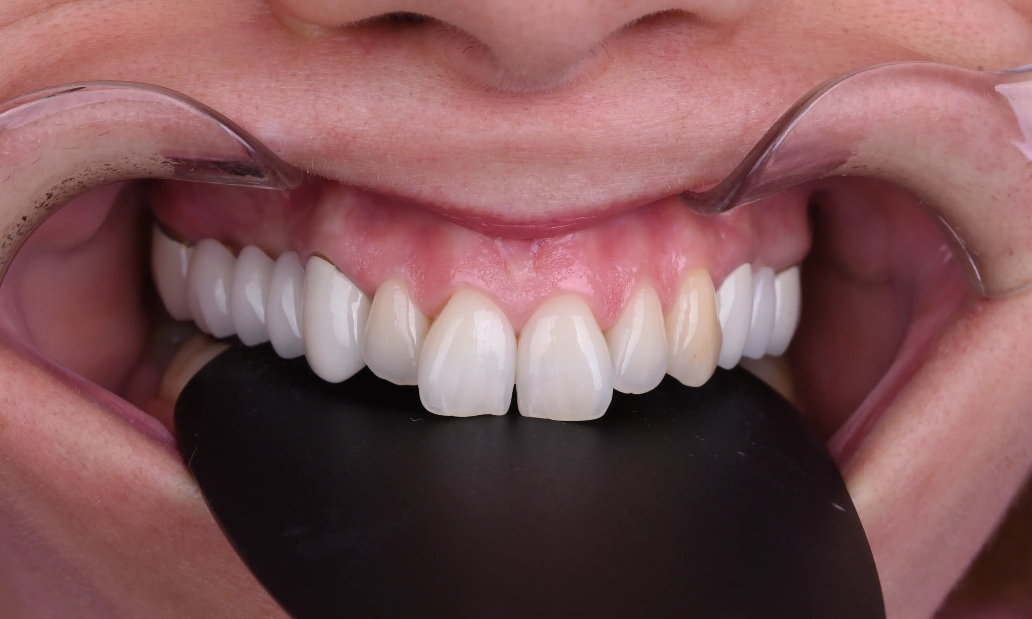 Full Veneers Before - Case 33 - Milim Dental Hospital Bursa