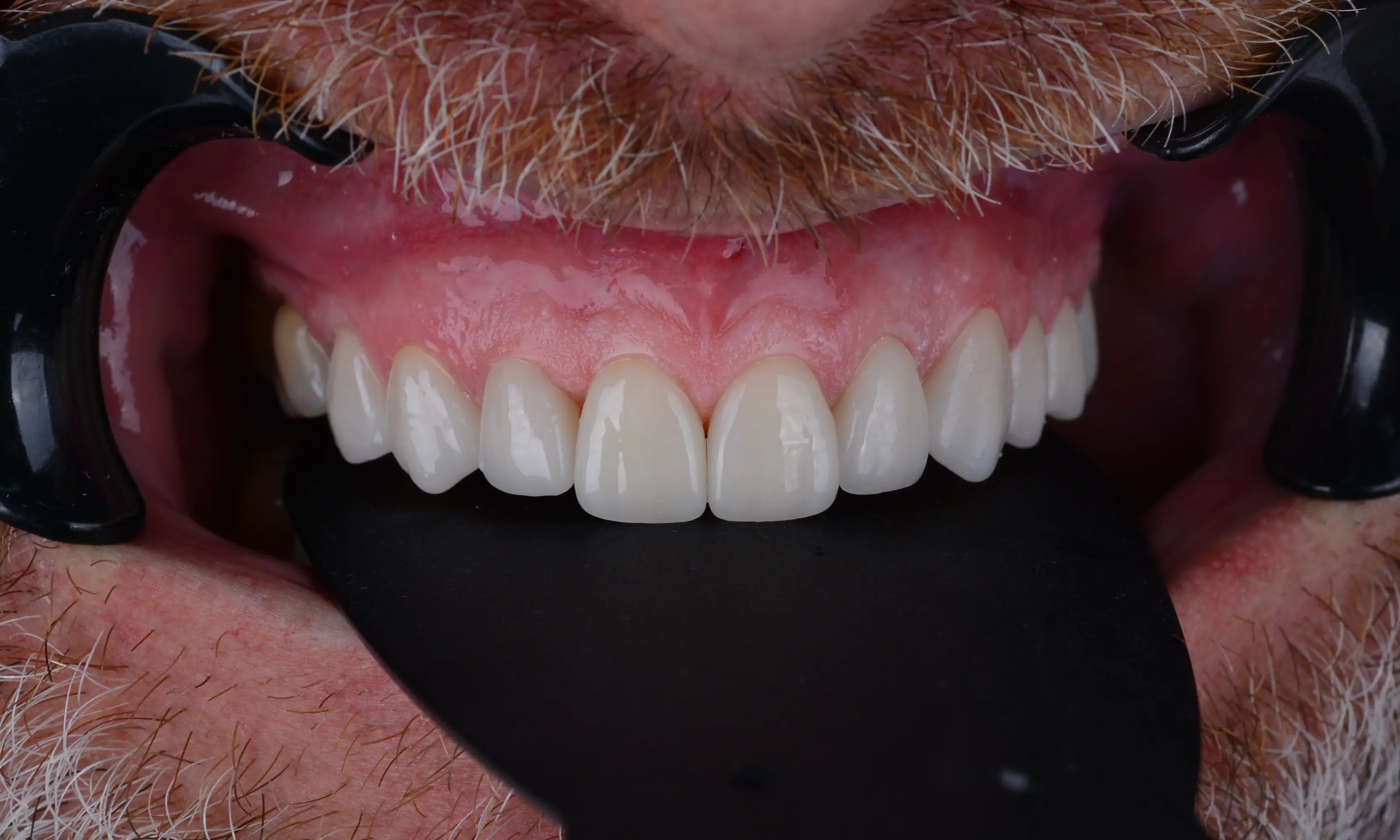 Full Veneers After - Case 38 - Milim Dental Hospital Bursa