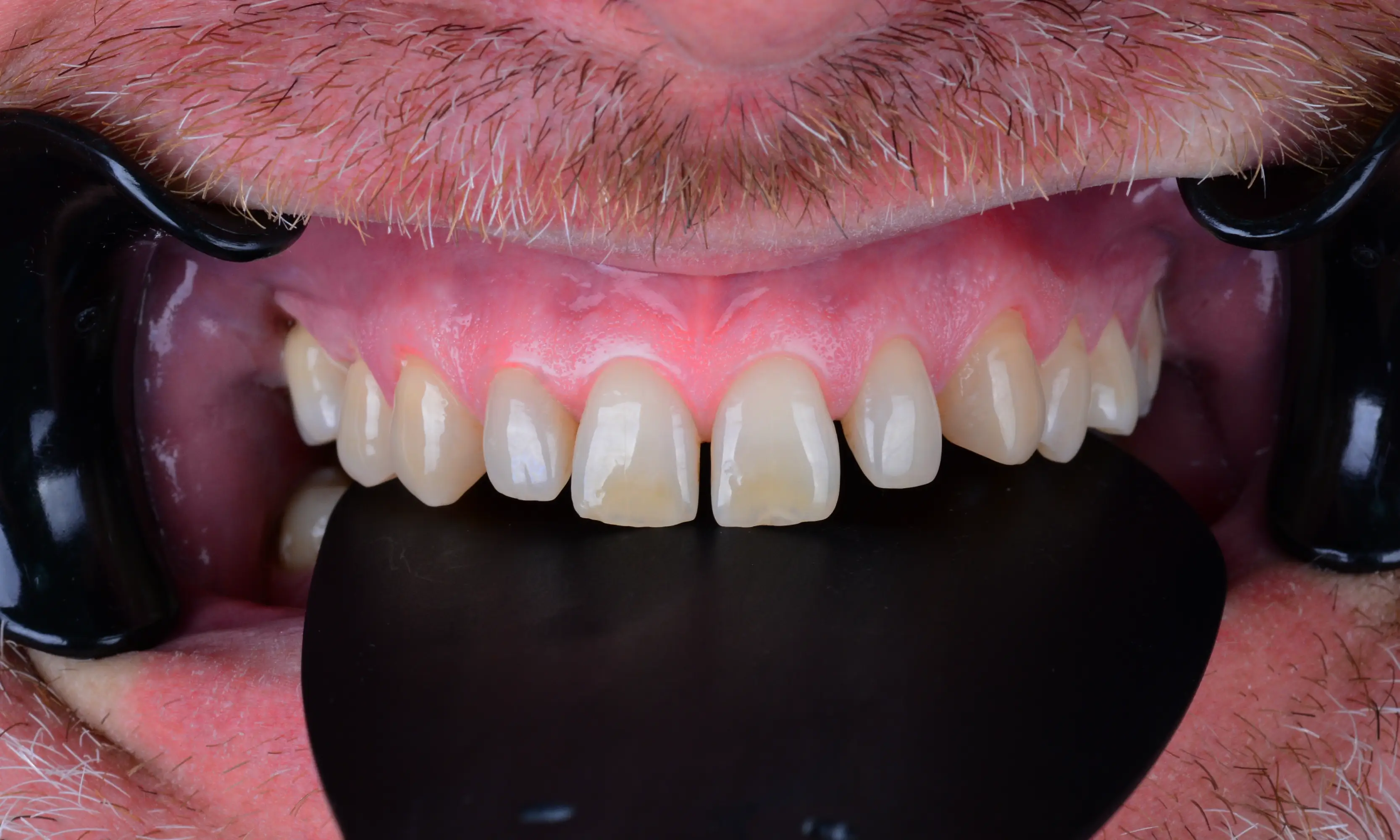 Full Veneers Before - Case 38 - Milim Dental Hospital Bursa