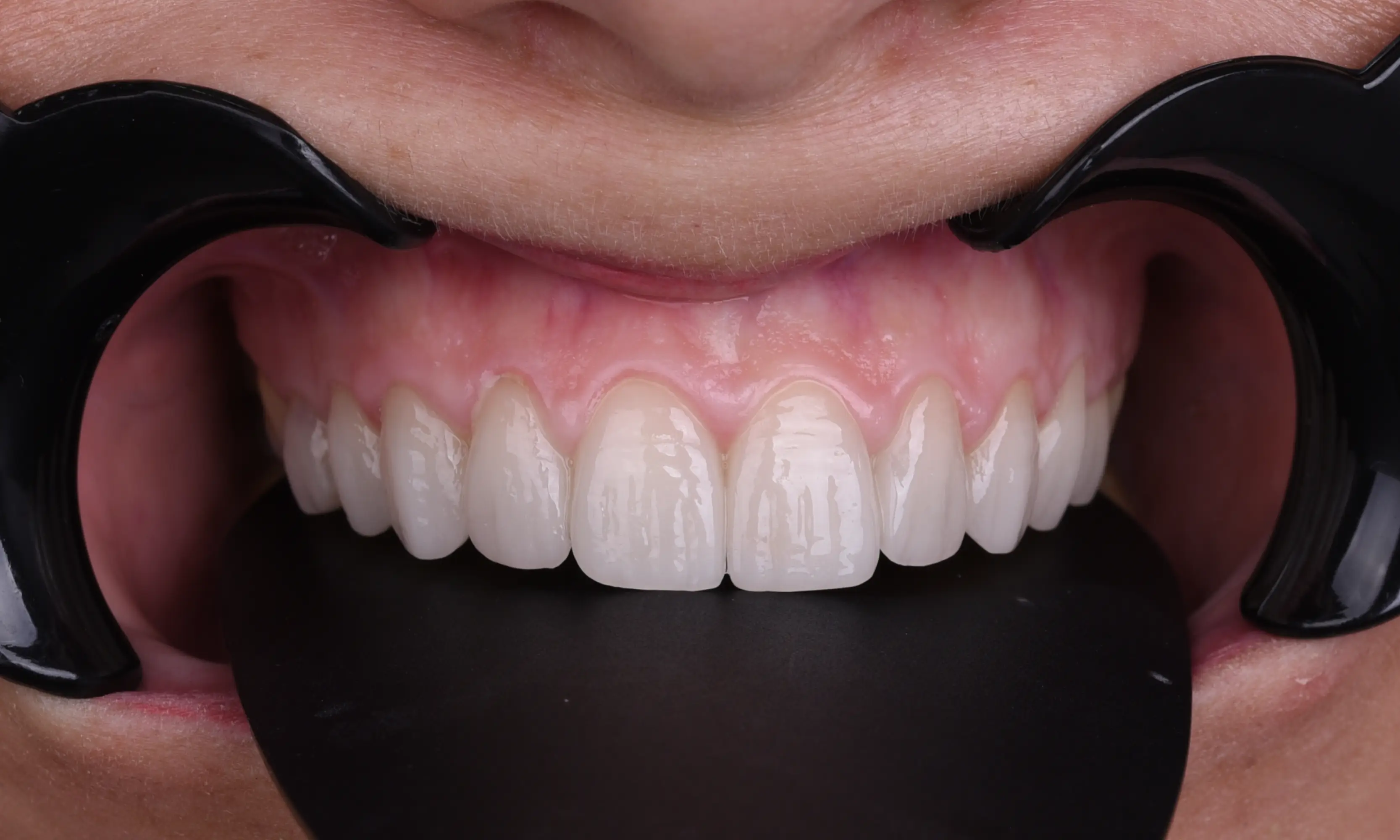Full Veneers After - Case 44 - Milim Dental Hospital Bursa