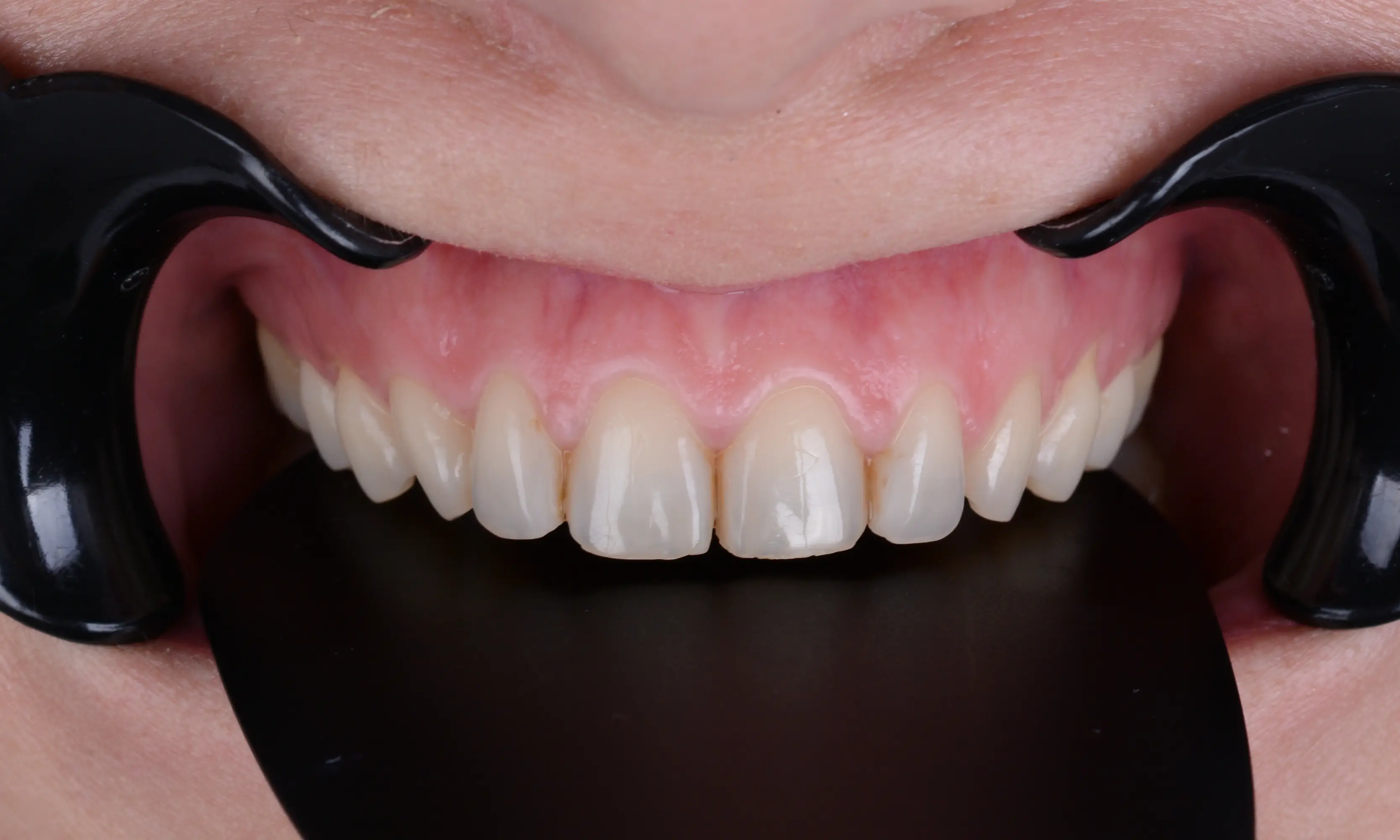Full Veneers Before - Case 44 - Milim Dental Hospital Bursa