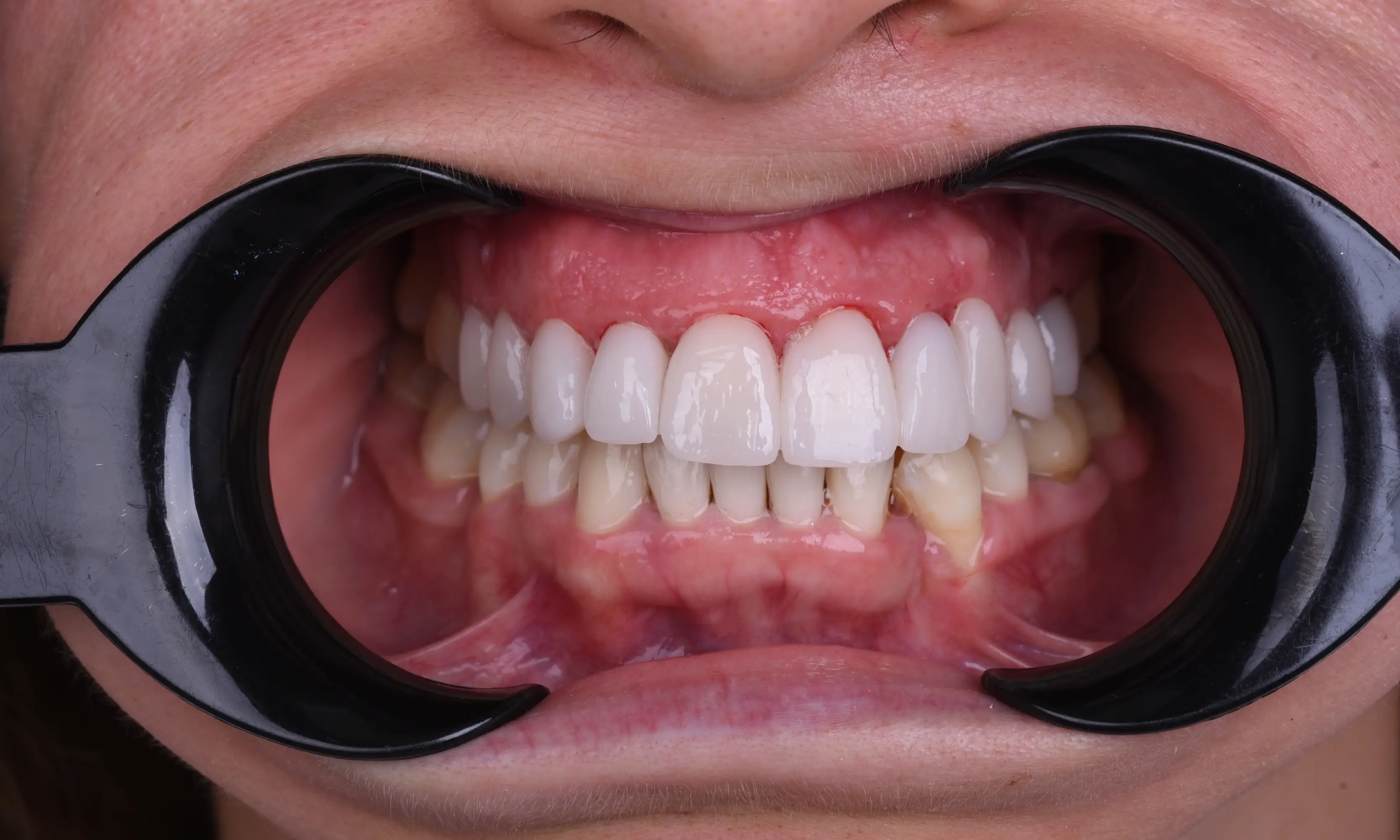 Full Veneers After - Case 45 - Milim Dental Hospital Bursa