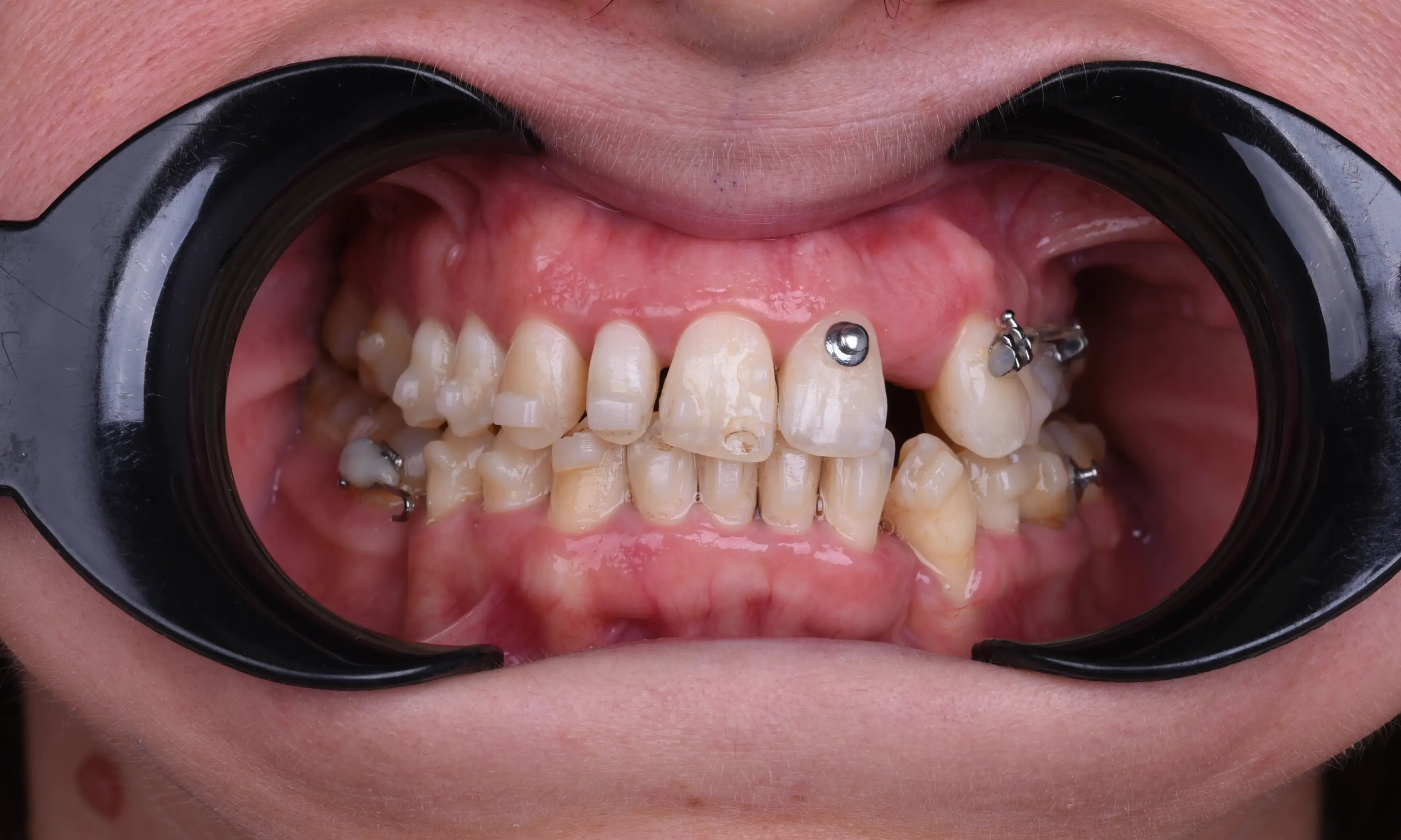 Full Veneers Before - Case 45 - Milim Dental Hospital Bursa