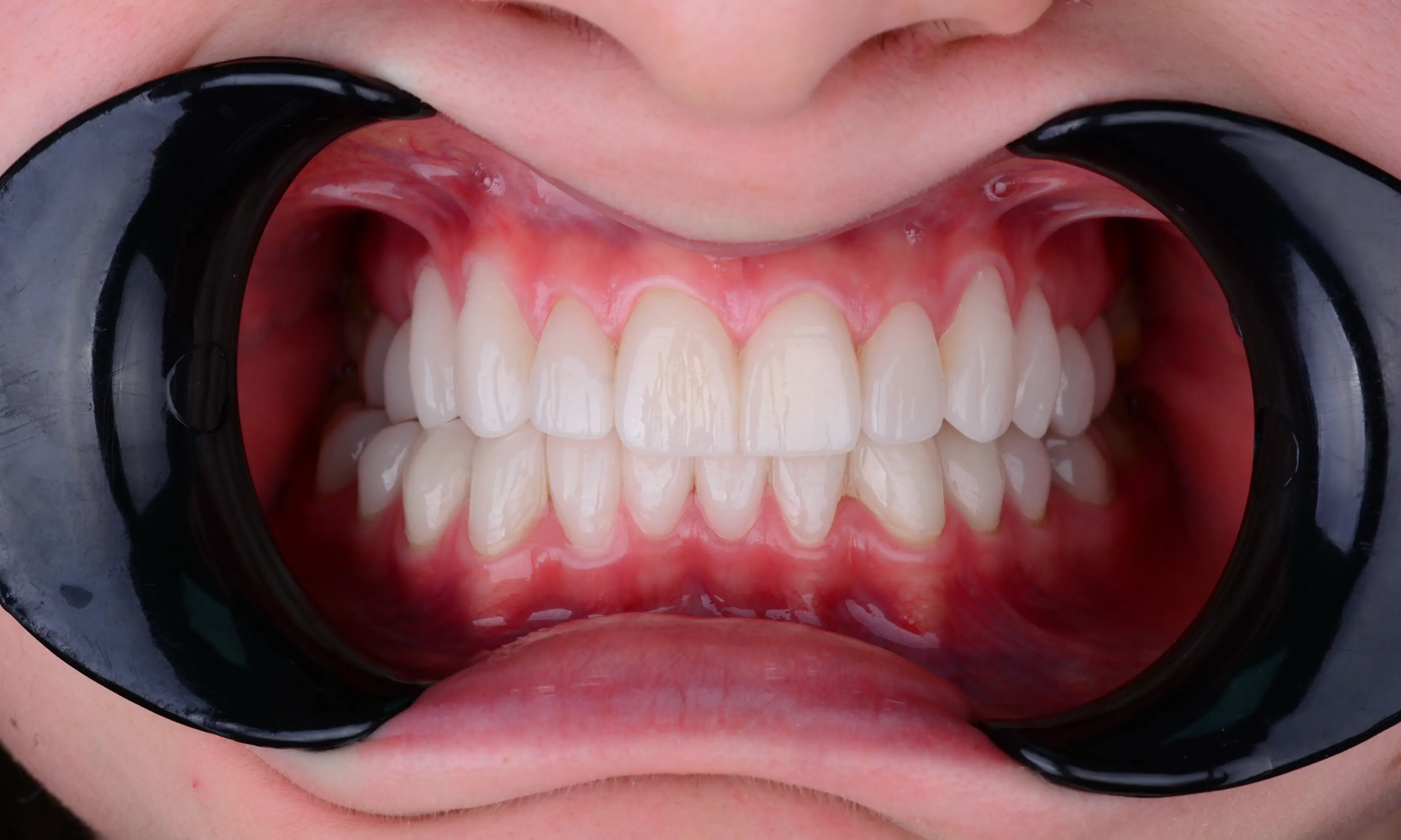 Full Veneers After - Case 47 - Milim Dental Hospital Bursa