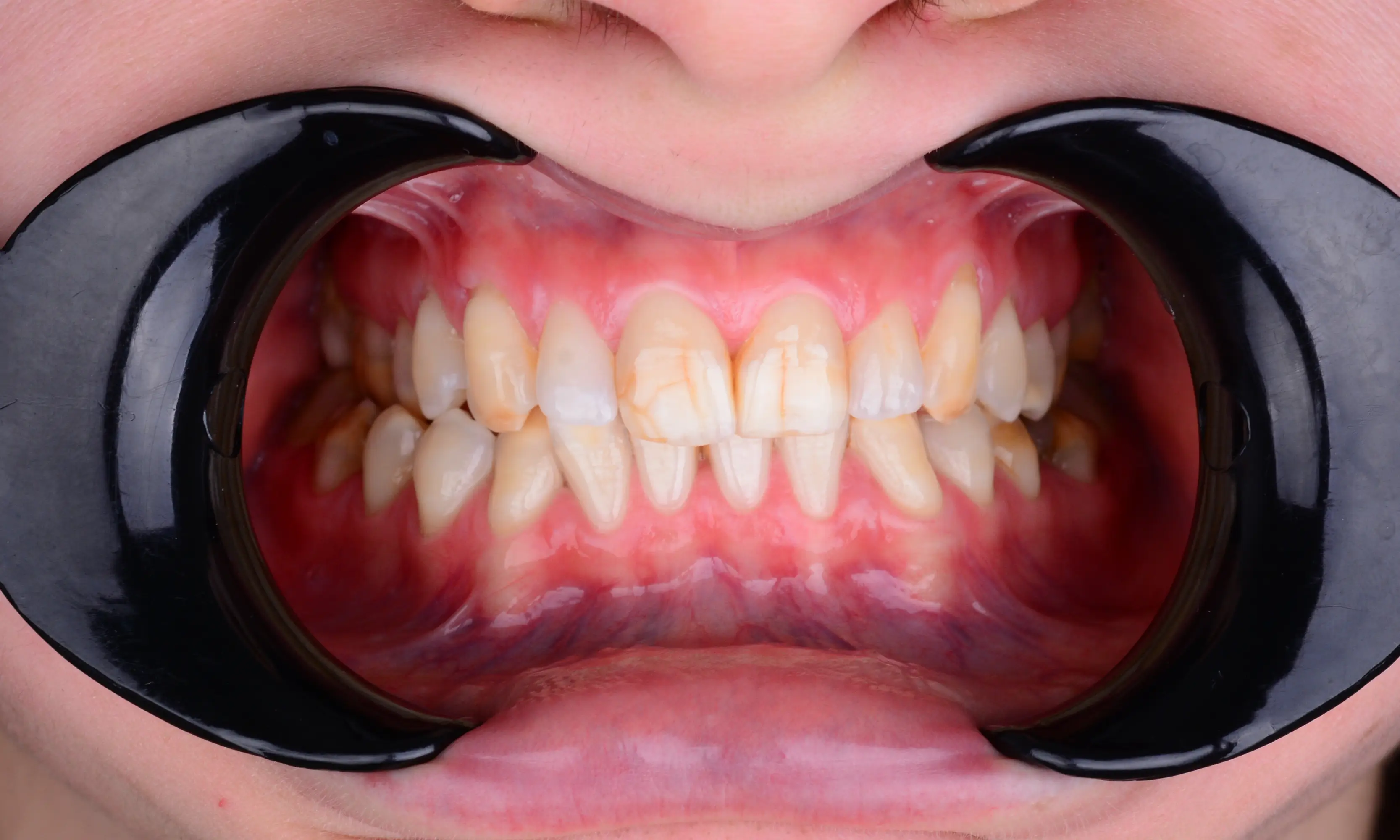 Full Veneers Before - Case 47 - Milim Dental Hospital Bursa