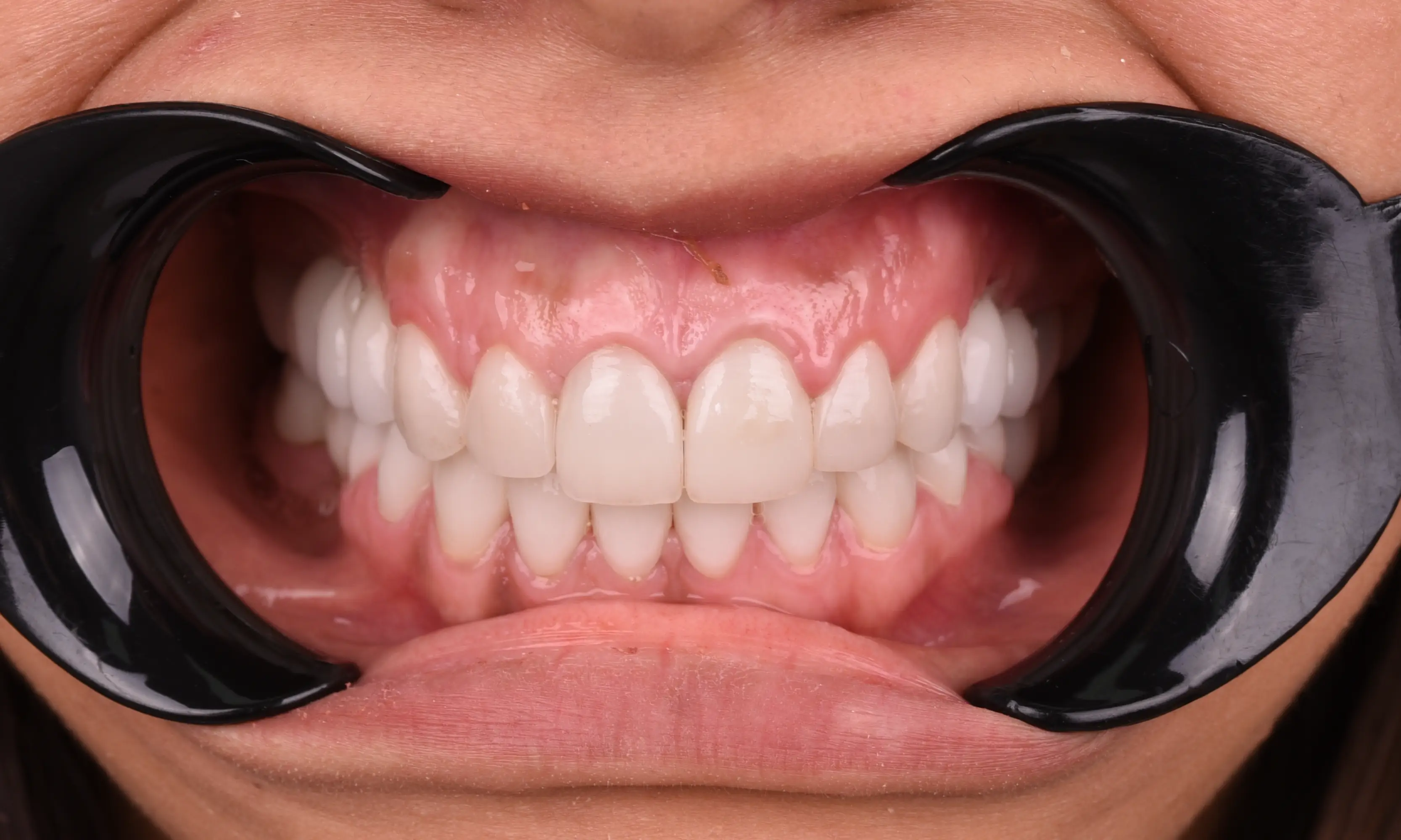 Full Veneers After - Case 52 - Milim Dental Hospital Bursa