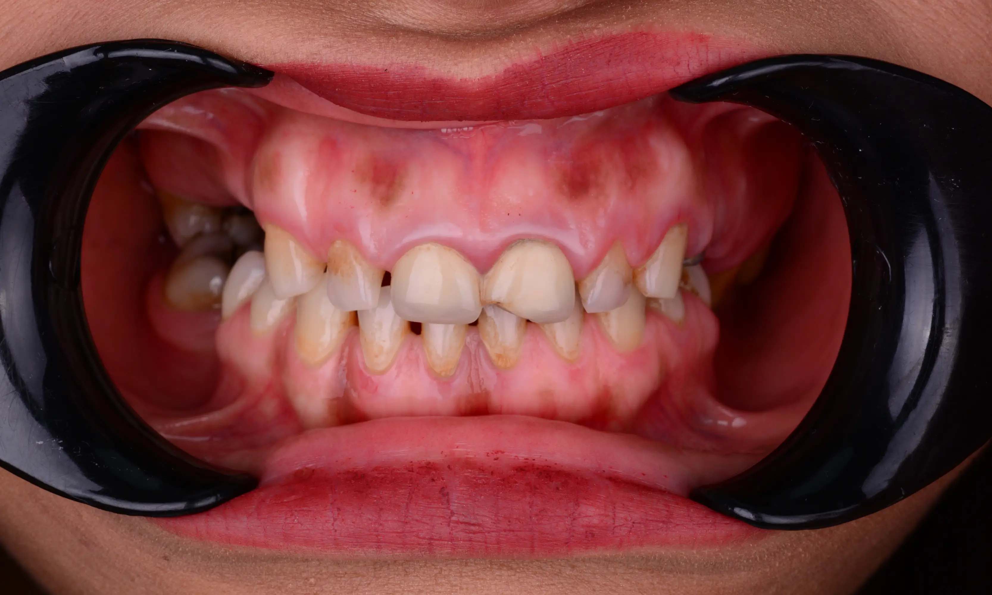 Full Veneers Before - Case 52 - Milim Dental Hospital Bursa
