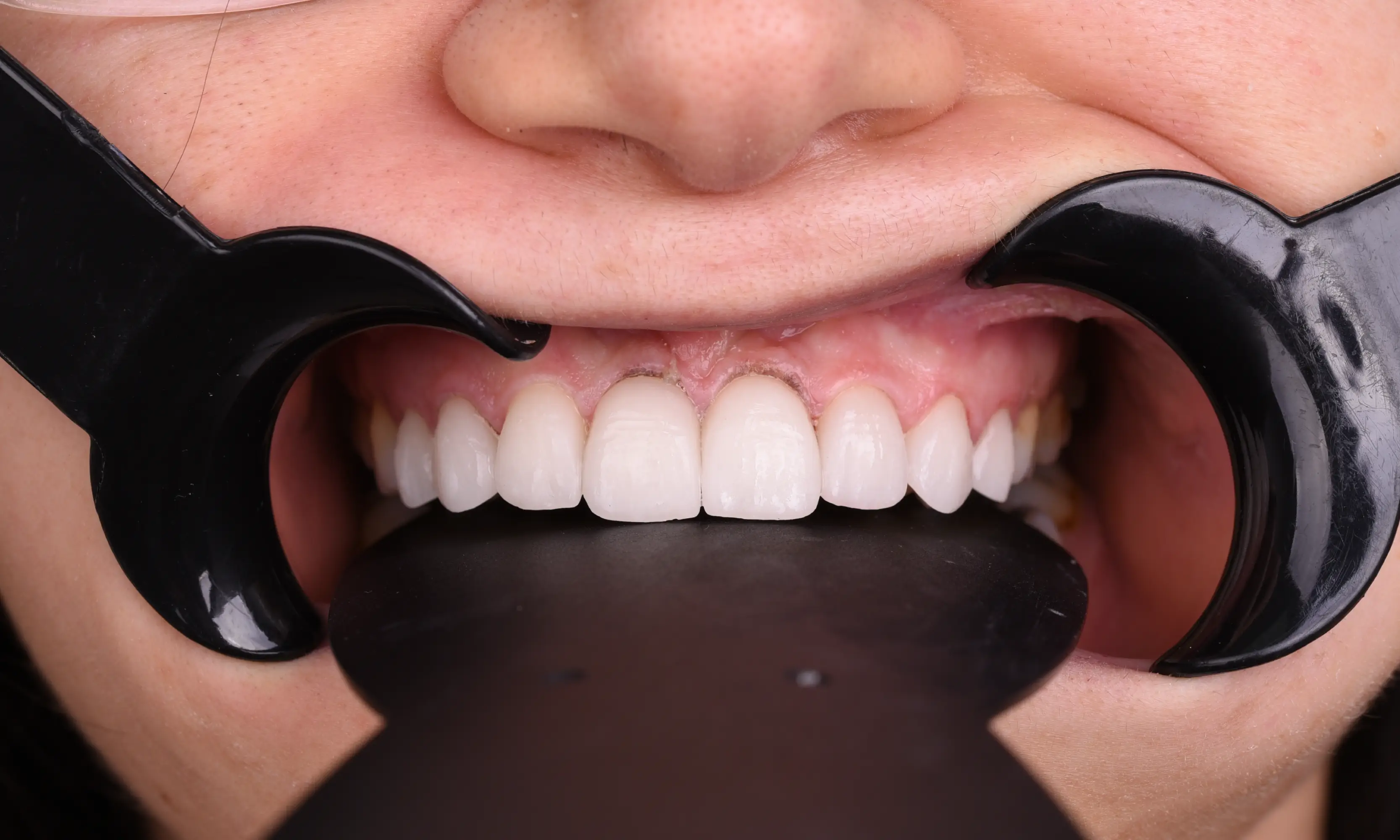 Full Zirconium After - Case 53 - Milim Dental Hospital Bursa