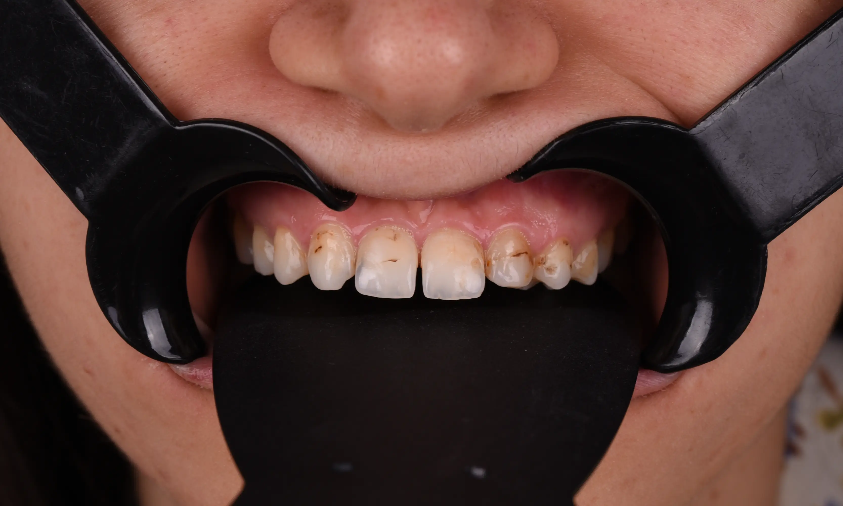 Full Zirconium Before - Case 53 - Milim Dental Hospital Bursa