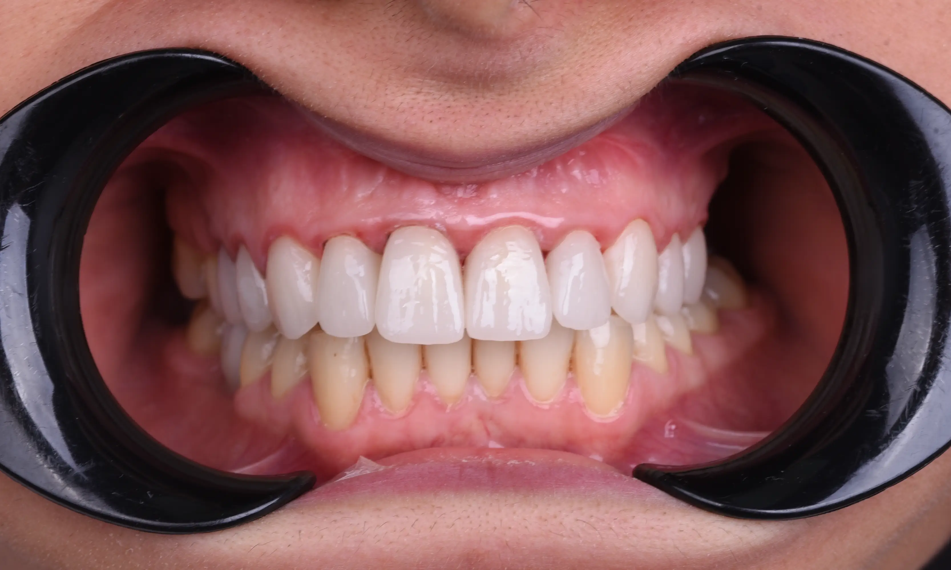 Full Zirconium After - Case 56 - Milim Dental Hospital Bursa
