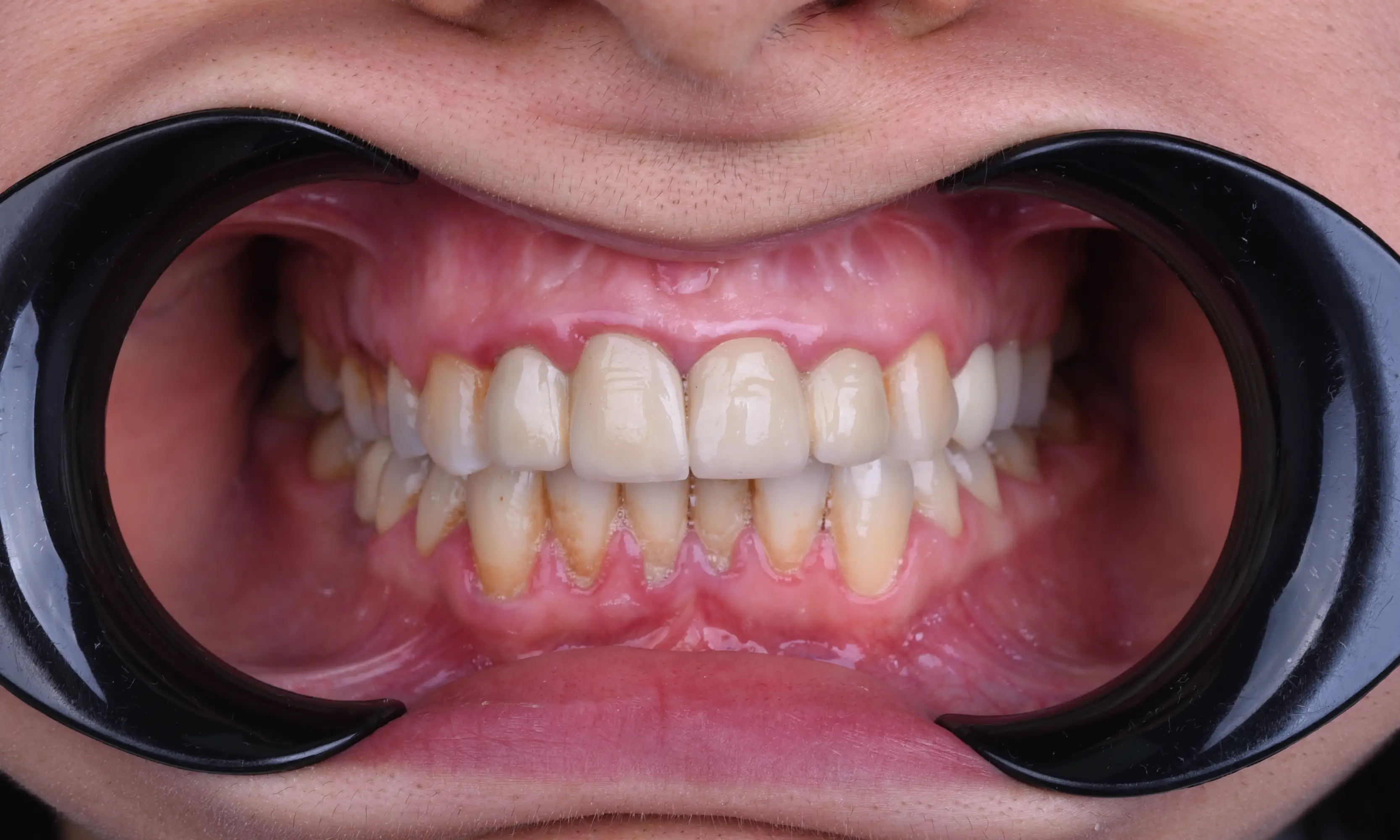 Full Zirconium Before - Case 56 - Milim Dental Hospital Bursa