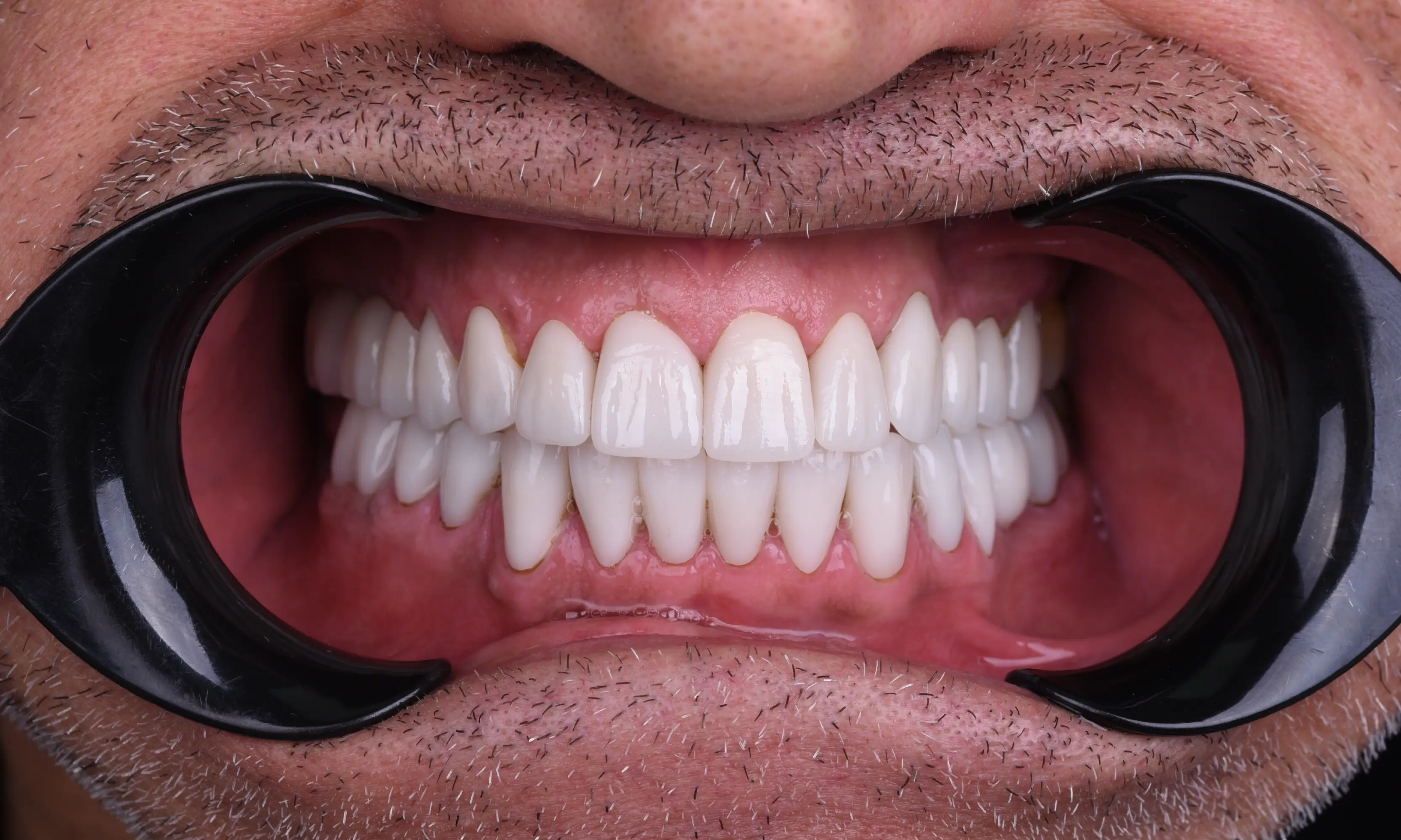 Full Zirconium After - Case 58 - Milim Dental Hospital Bursa