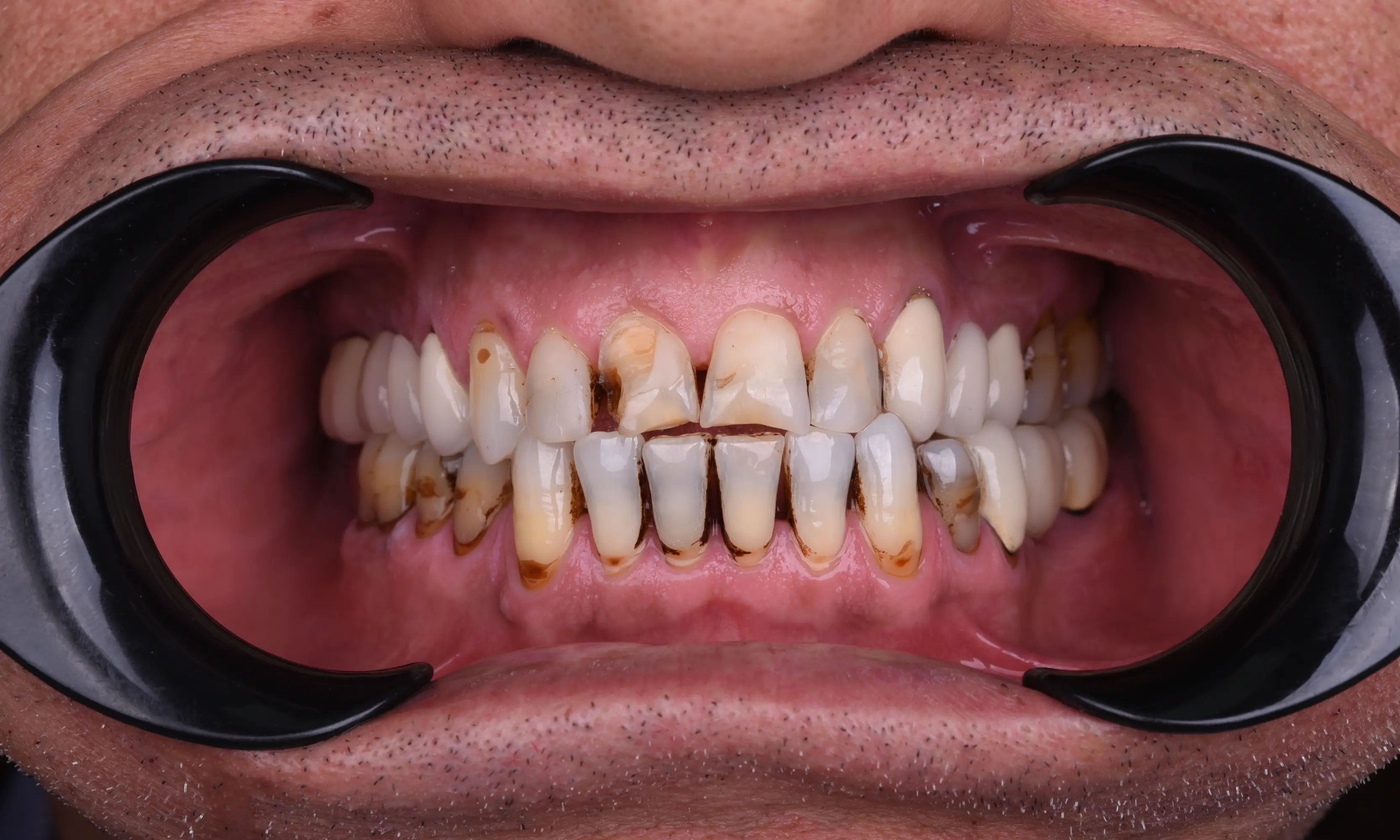 Full Zirconium Before - Case 58 - Milim Dental Hospital Bursa