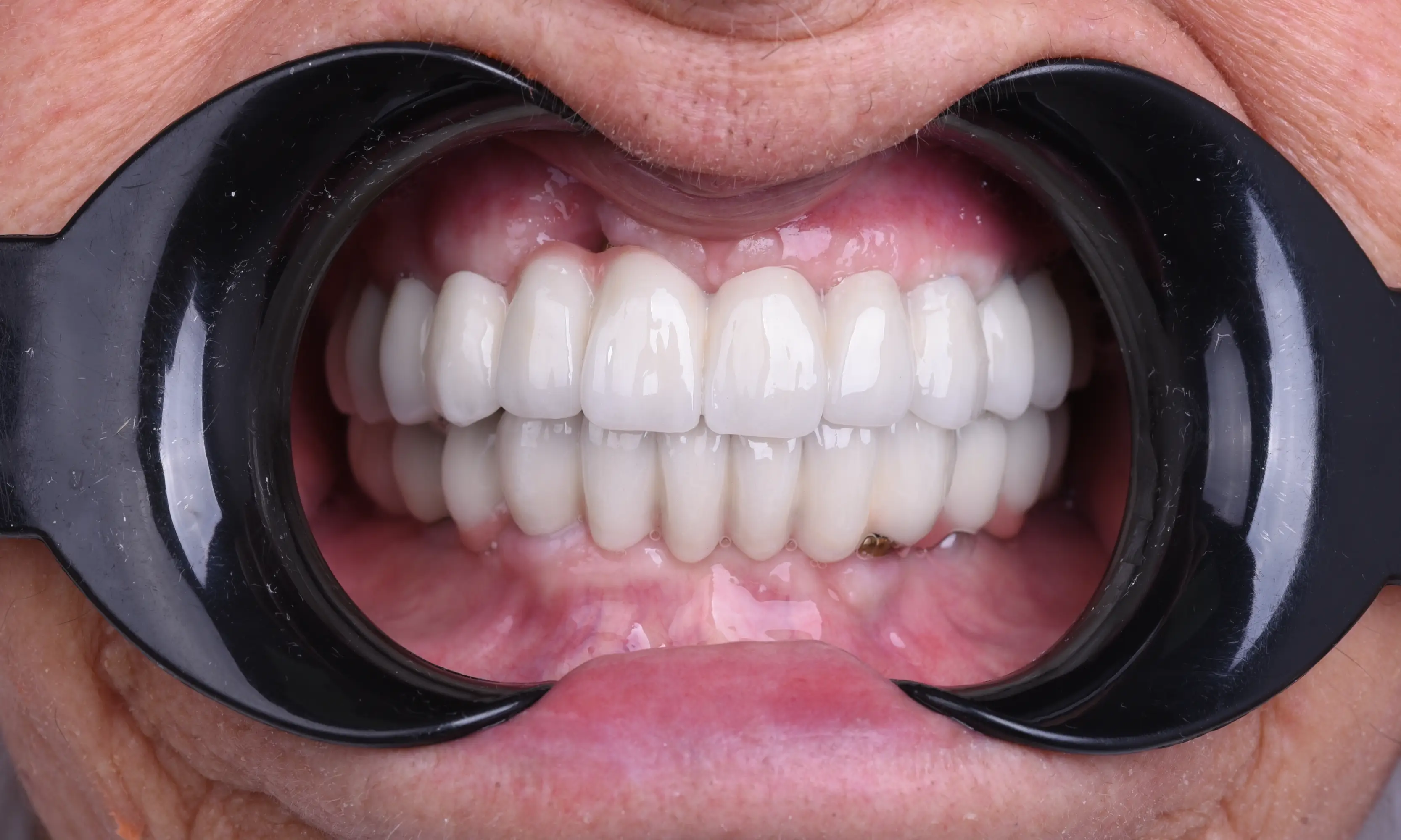 All on X After - Case 6 - Milim Dental Hospital Bursa
