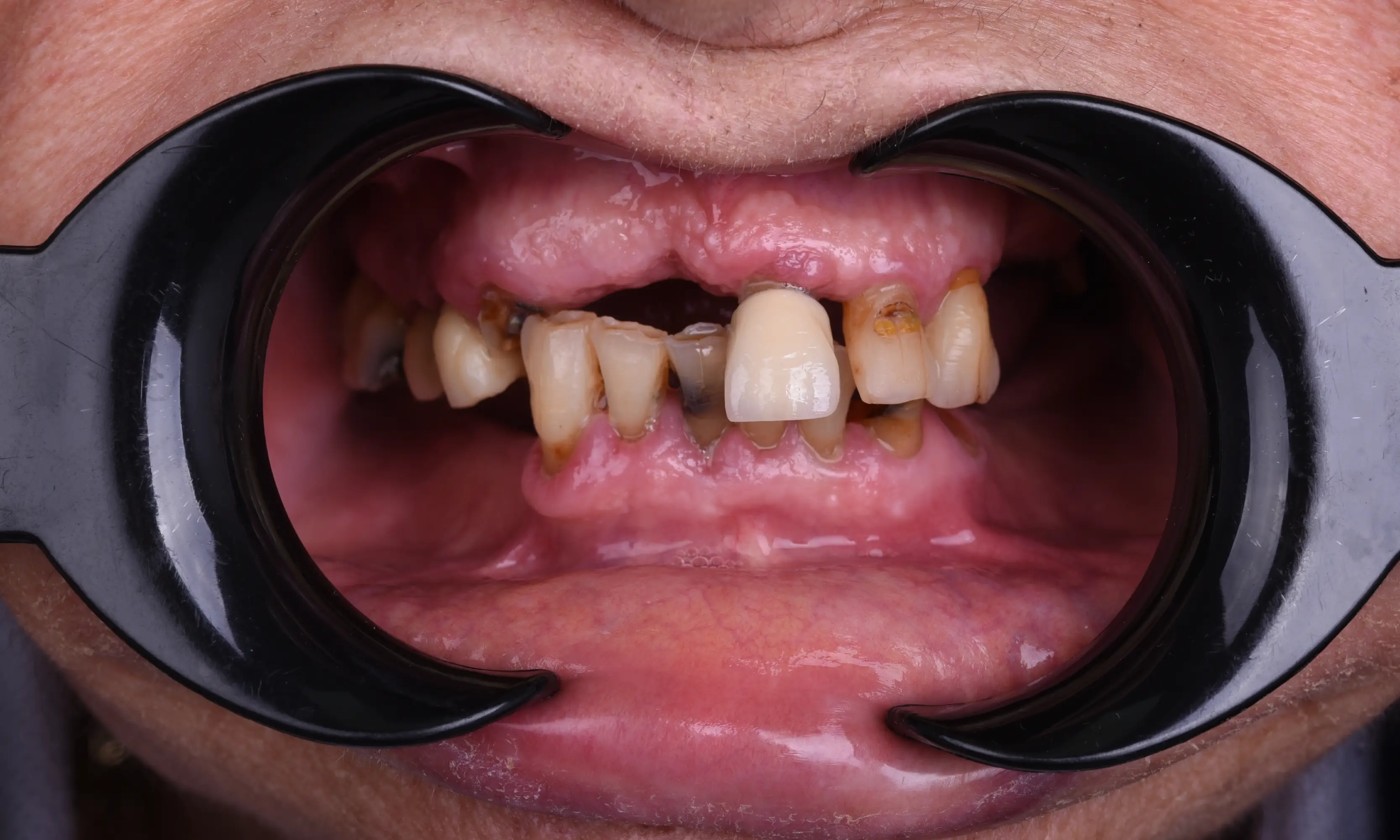 All on X Before - Case 6 - Milim Dental Hospital Bursa
