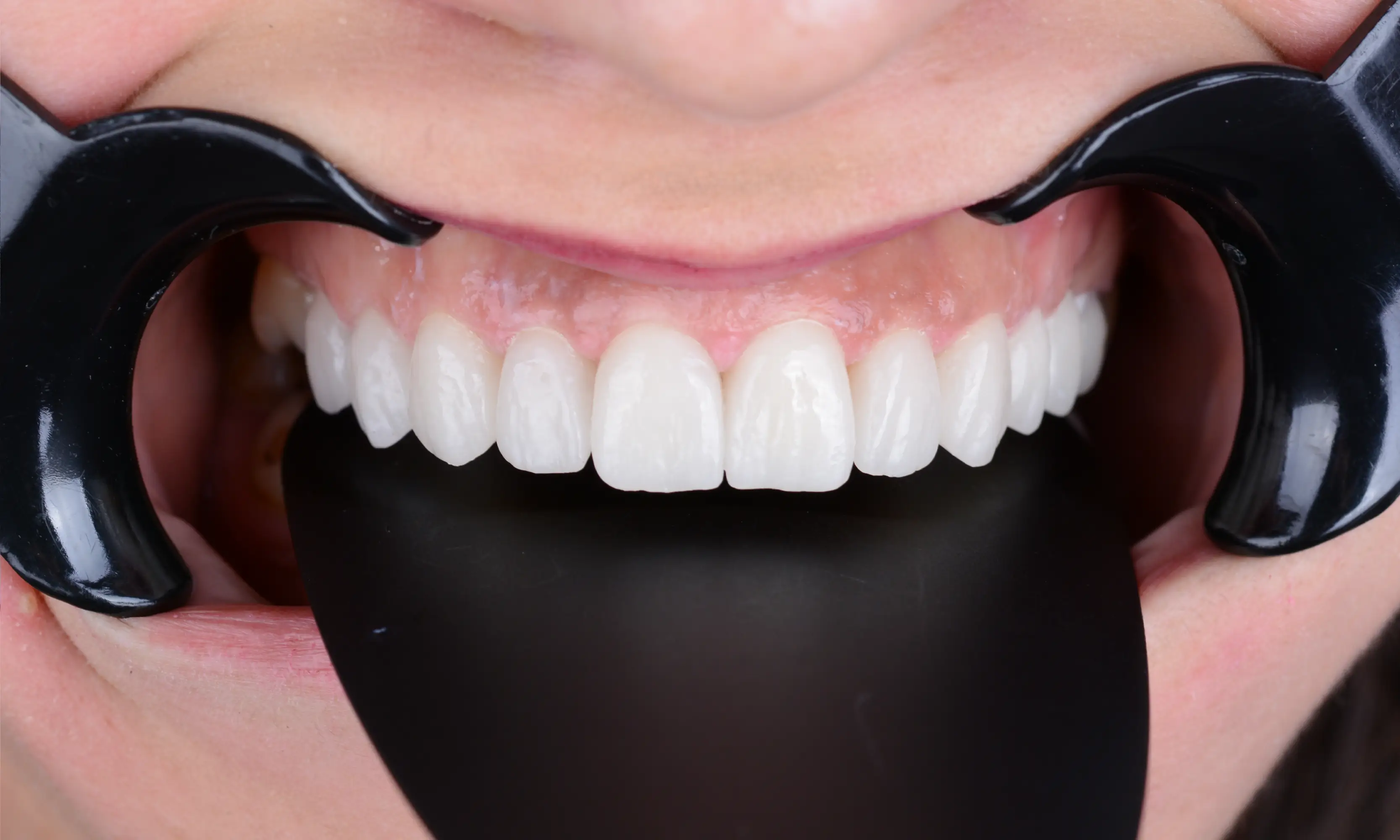 Full Zirconium After - Case 62 - Milim Dental Hospital Bursa