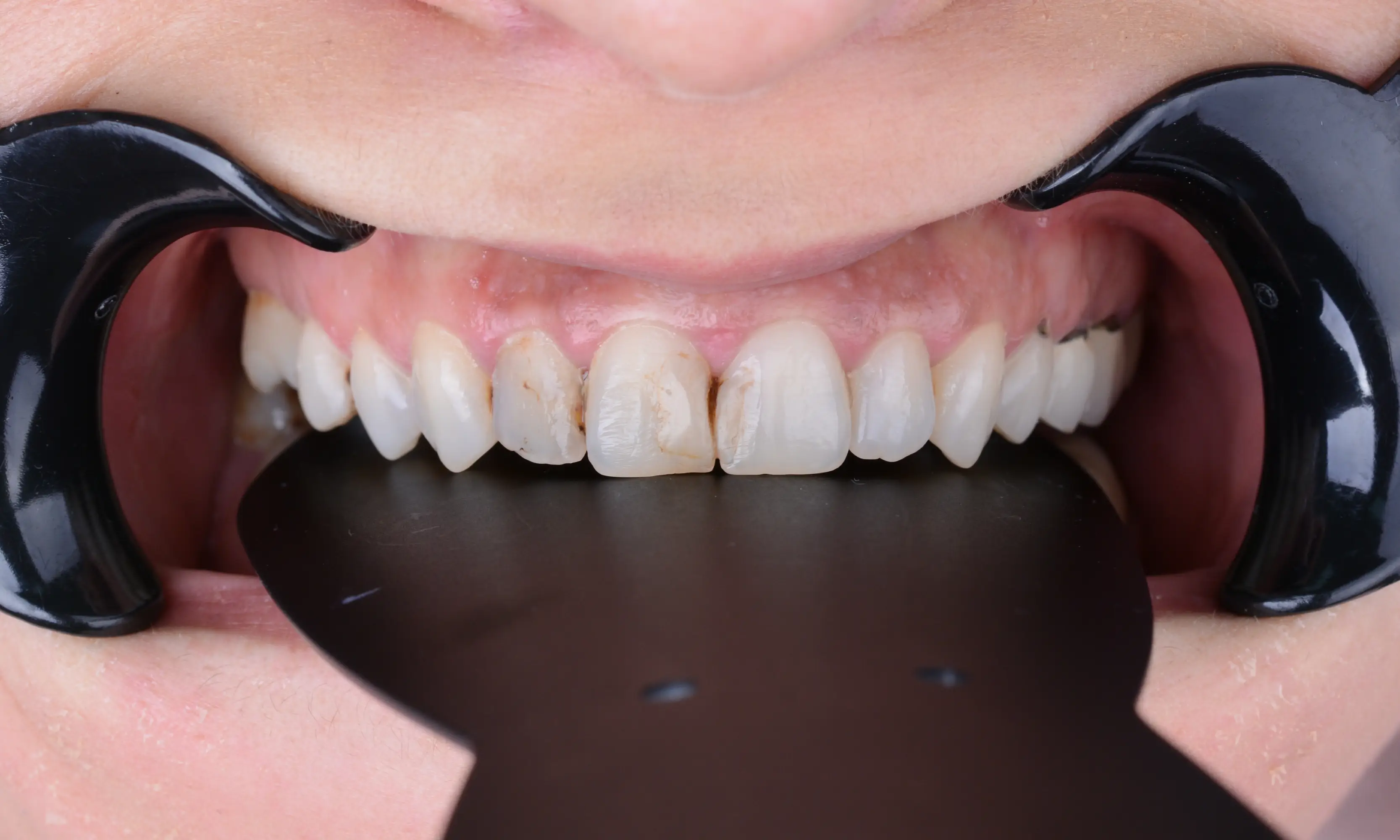 Full Zirconium Before - Case 62 - Milim Dental Hospital Bursa
